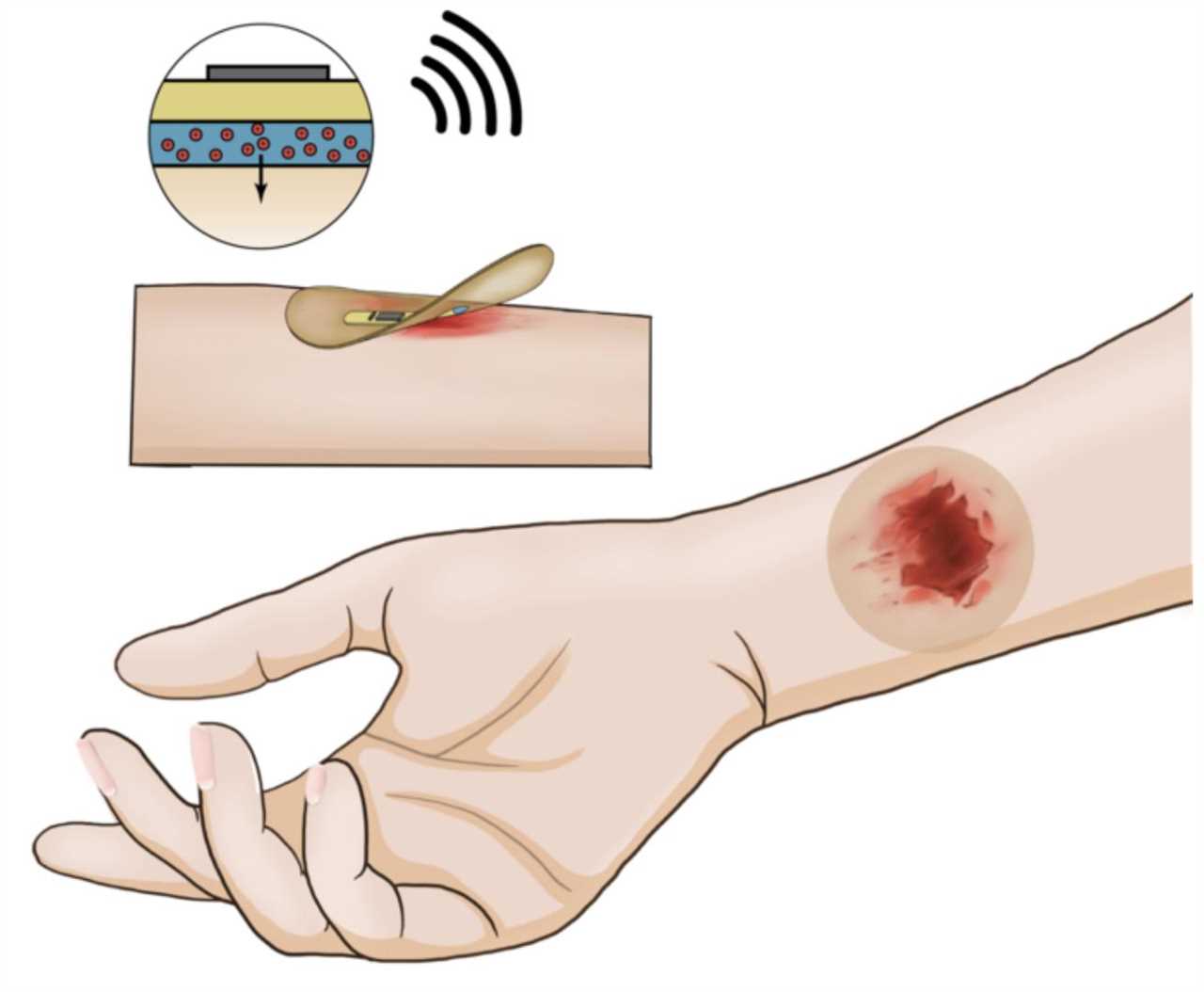 New insights from wireless smart bandage for healing chronic wounds